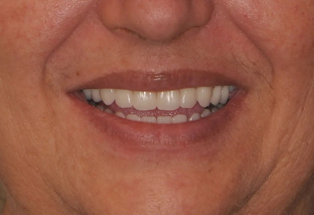 After dental implant operation photo.