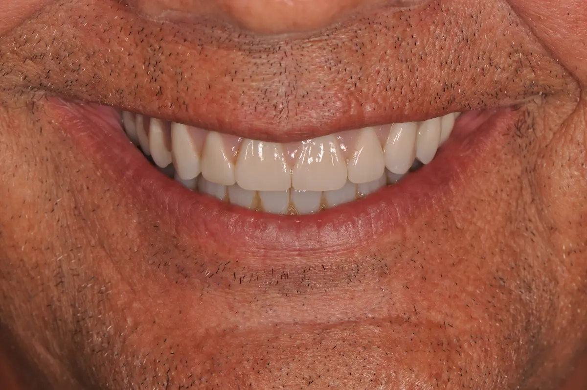 After dental implant operation photo.