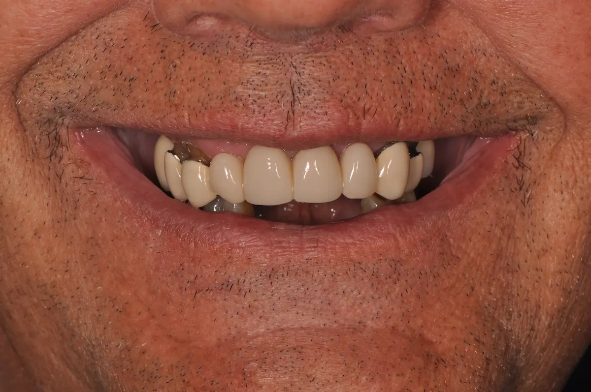 Before dental implant operation photo.