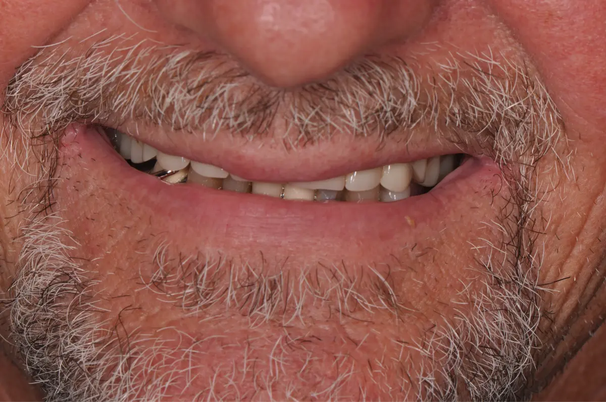 Before dental implant operation photo.